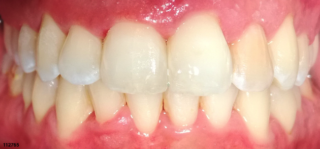 Overbite - After Image