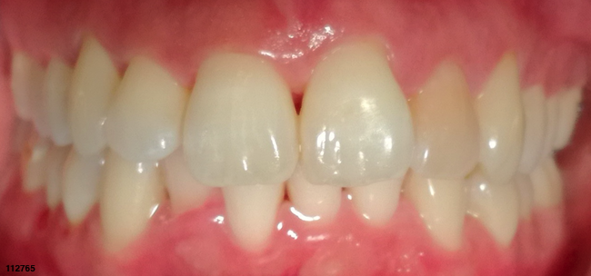 Overbite - Before Image