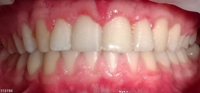 Crossbite - After Image