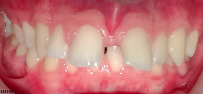 Crossbite - Before Image